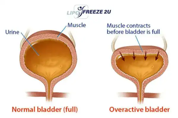 diagram of overactive bladder treatment Hanwell
