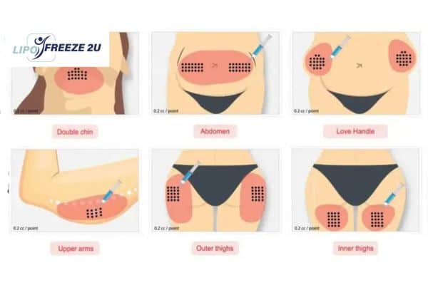 Benefits of Choosing Aqualyx for Fat Reduction Hanwell