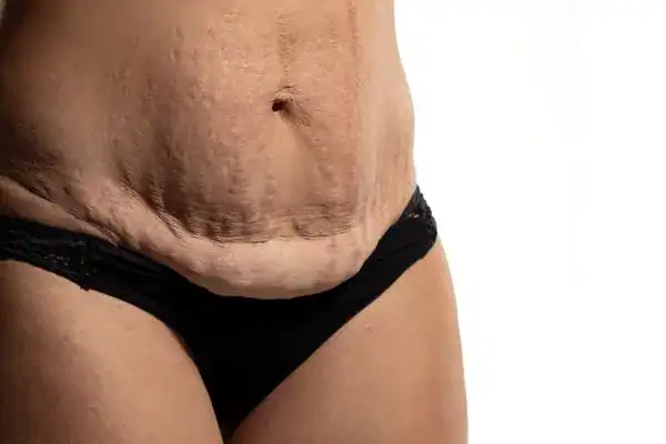 loose skin after weight loss injections Hanwell