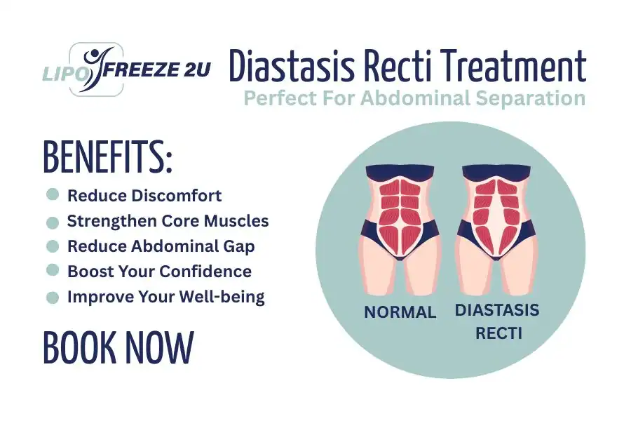 How Long Will It Take to See Improvements in Diastasis Recti Hanwell