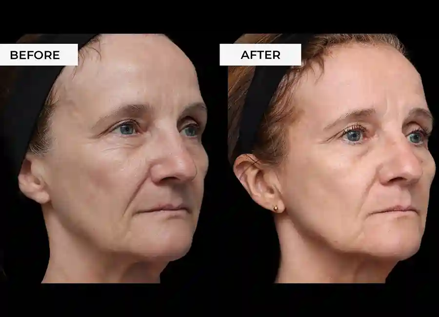 How Many RF Microneedling Sessions Will You Need to See a Difference Hanwell?