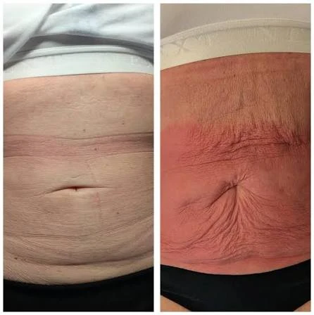 How Does RF Microneedling Improve Crepey, Thin and Uneven Skin Texture Hanwell?