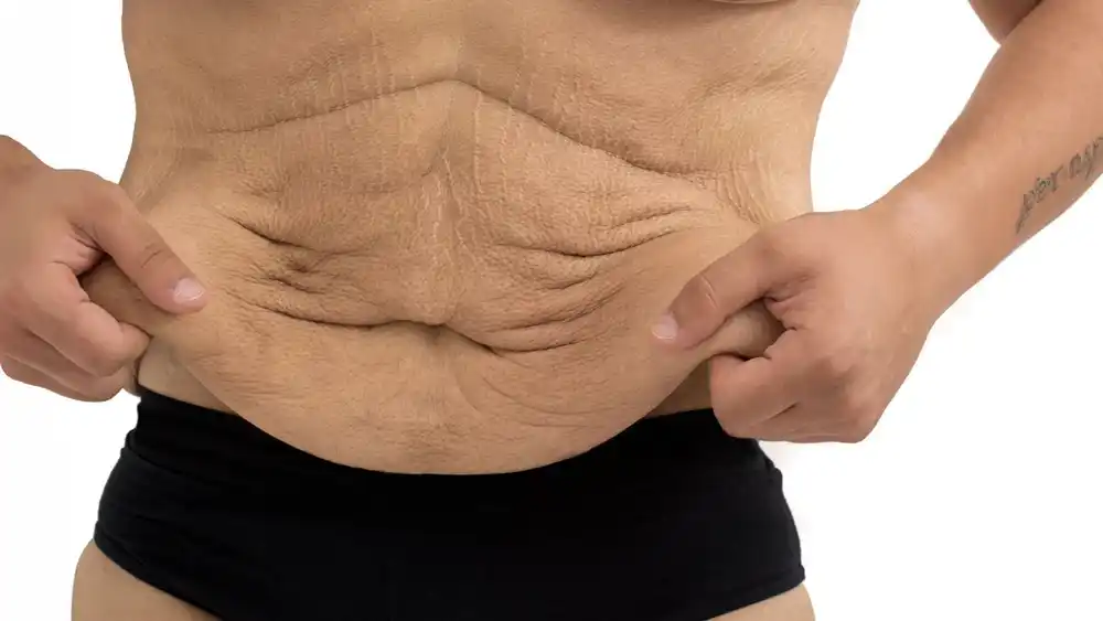Why Does Weight Loss Medication Leave Some People With Loose or Sagging Skin Hanwell?